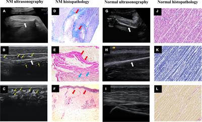 Case Report: Prenatal Diagnosis of Nemaline Myopathy